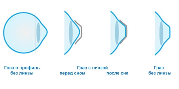 ОК-терапия